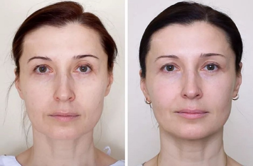 Operației estetice de înlăturarea ridurilor