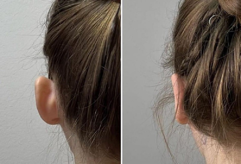 Otoplastie – operație estetică la urechi