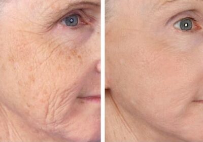 wrinkled-face-before-and-after-Wrinkles-lasermedmolodova-chisinau
