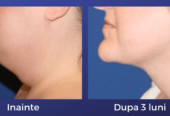 Liposuctia laser: eliminarea barbiei duble