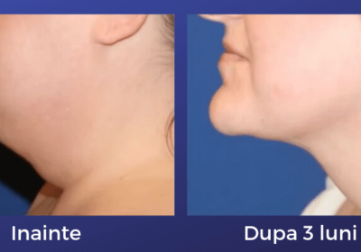 Liposuctia-laser-eliminarea-barbiei-duble-Moldova