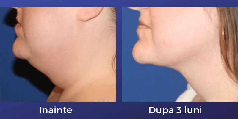 Liposuctia laser: eliminarea barbiei duble