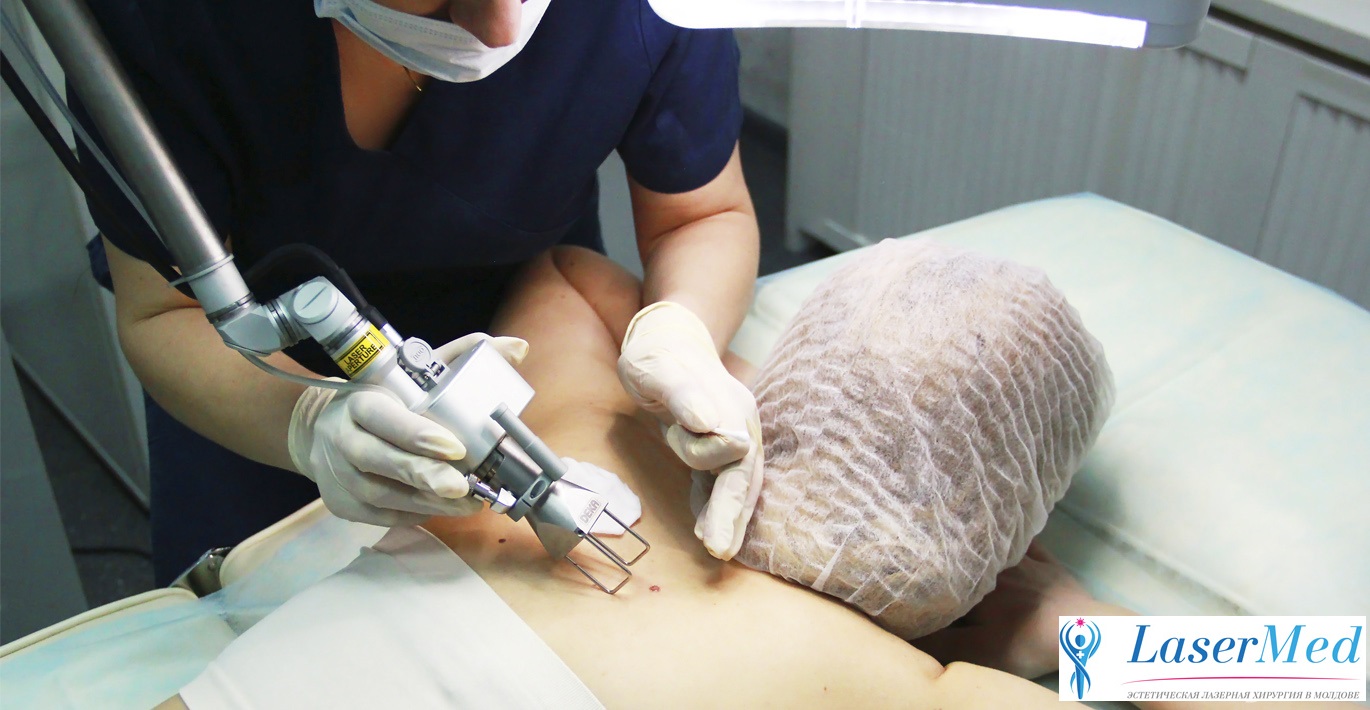  Лазерное удаление новообразований родинок невусов