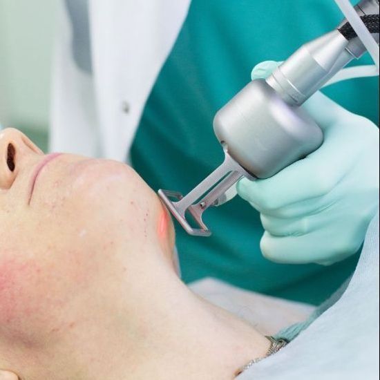 Tratament cu laser pentru indepartarea si  elimina