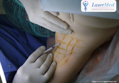 Protsedura-lecheniya-povyshennoj-potlivosti-gipergidroza-v-Moldove-lasermed