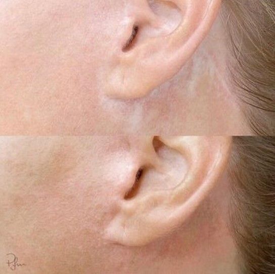 Tratament cu laser pentru indepartarea si  elimina