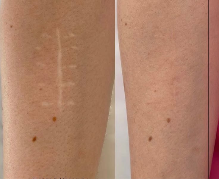 Tratament cu laser pentru indepartarea si  elimina