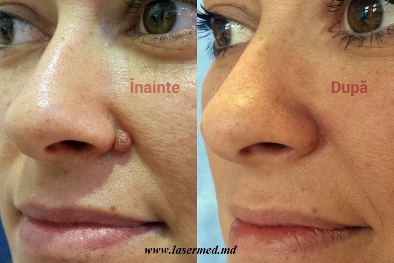  Лазерное удаление новообразований родинок невусов