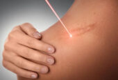 Corecția și eliminarea cicatricelor cu laser 