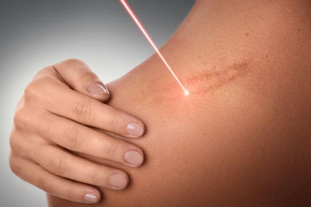 Corecția și eliminarea cicatricelor cu laser 