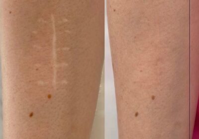 Tratament-cu-laser-pentru-indepartarea-si-eliminarea-corectia-cicatricelor-in-cabinetul-de-chirurgie-laser-LaserMedChisinau-in-Moldova