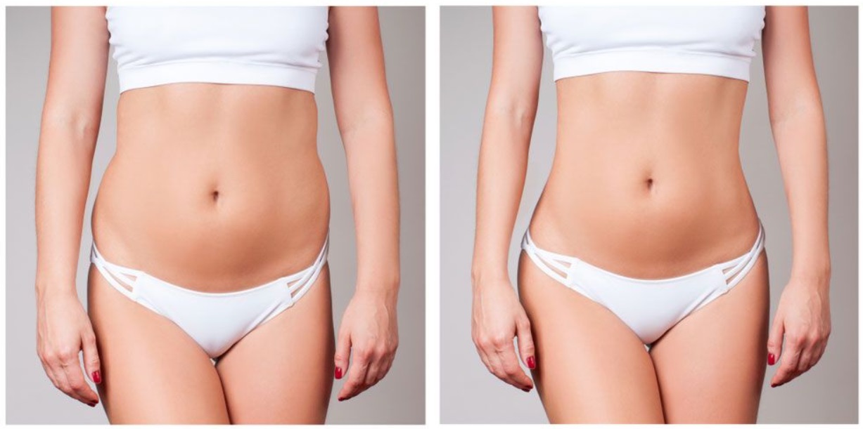 BodyTite: современная радиочастотная липосакция