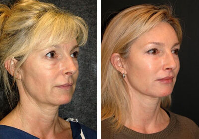 Podtyazhka-litsa-Nefertiti-metodom-3D-HIFU-ultrazvukovoj-SMAS-lifting