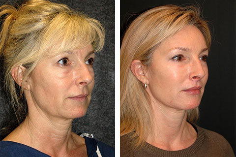 АкцииСпециальные акции на процедуры к 8 Марта