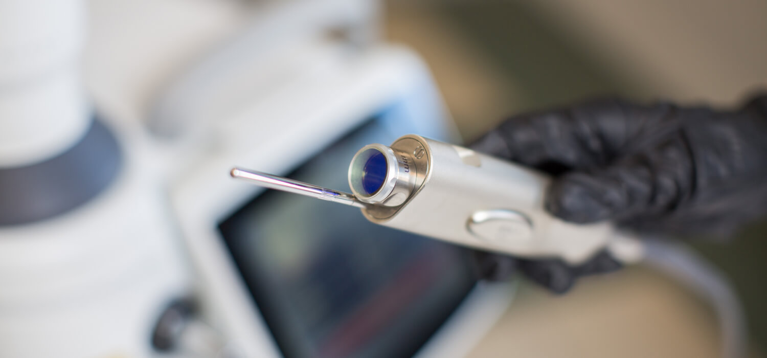 Лазерное удаление кондиломы и генитальных бородаво