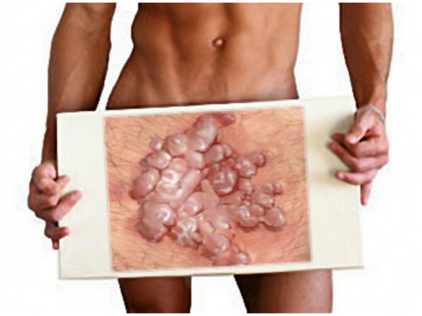 Лазерное удаление кондиломы и генитальных бородаво