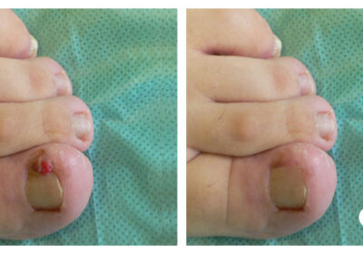 Corectie-laser-Tratament-laser-a-unghiei-incarnate-in-Chisinau-Moldova