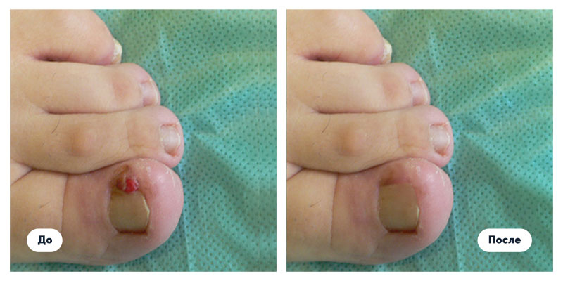 Лазерное удаление ( коррекция) вросшего ногтя!