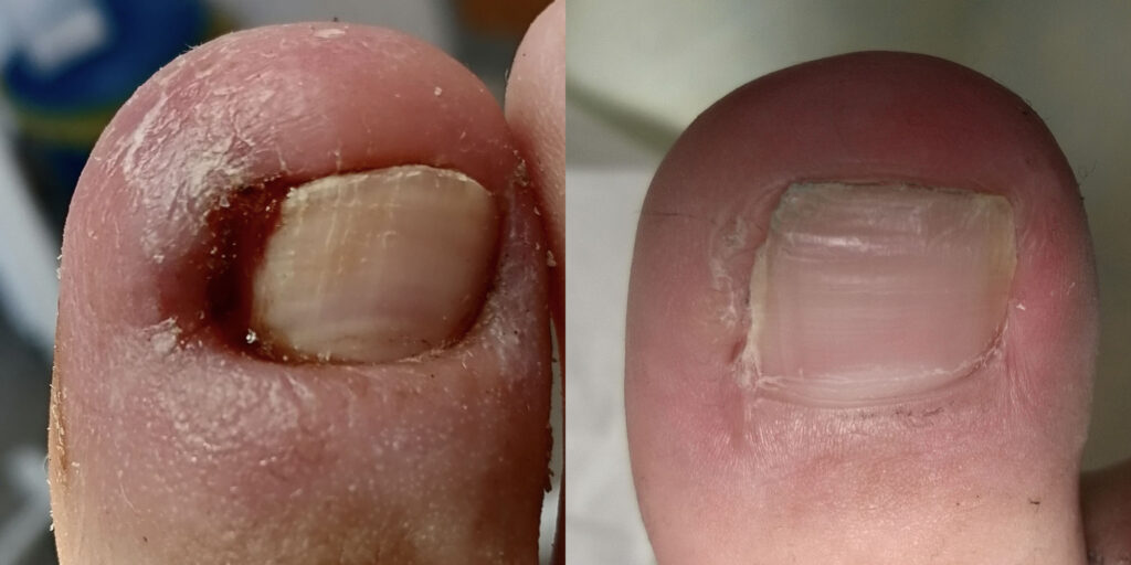 Лазерное удаление ( коррекция) вросшего ногтя!