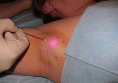 Tratamentul-cu-laser-a-hiperhidrozei-axilare-in-Chisinau