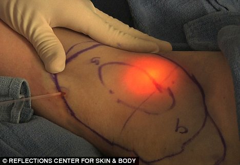 Лечение гипергидроза (потливости) подмышек лазером