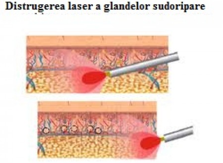 Лечение гипергидроза (потливости) подмышек лазером