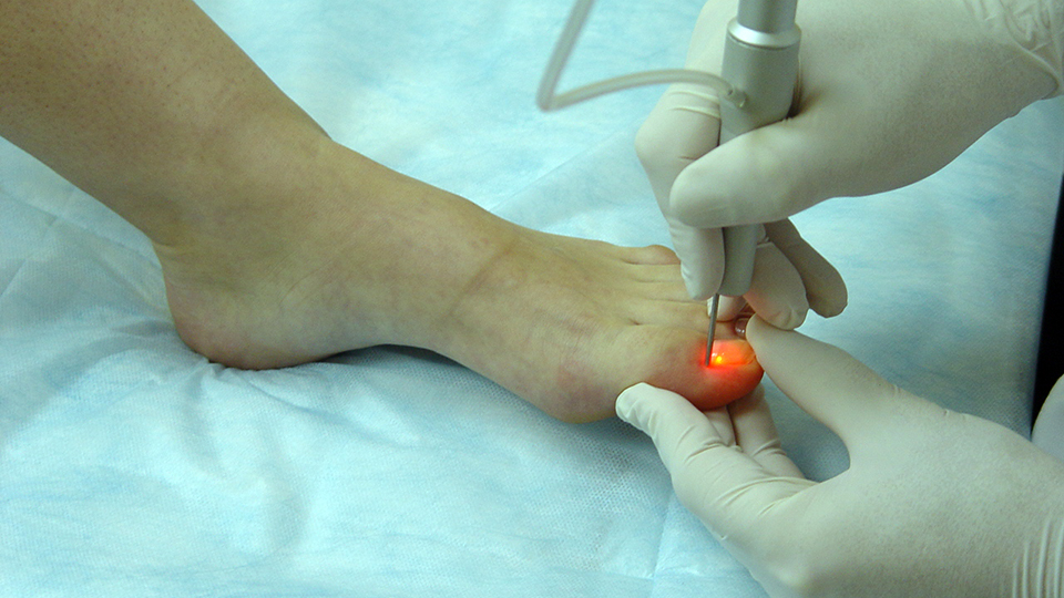 Лазерное удаление ( коррекция) вросшего ногтя!