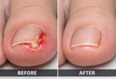 Лазерное удаление ( коррекция) вросшего ногтя!