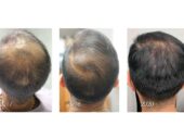 PRP terapie (Platelet Rich Plasma) in Moldova