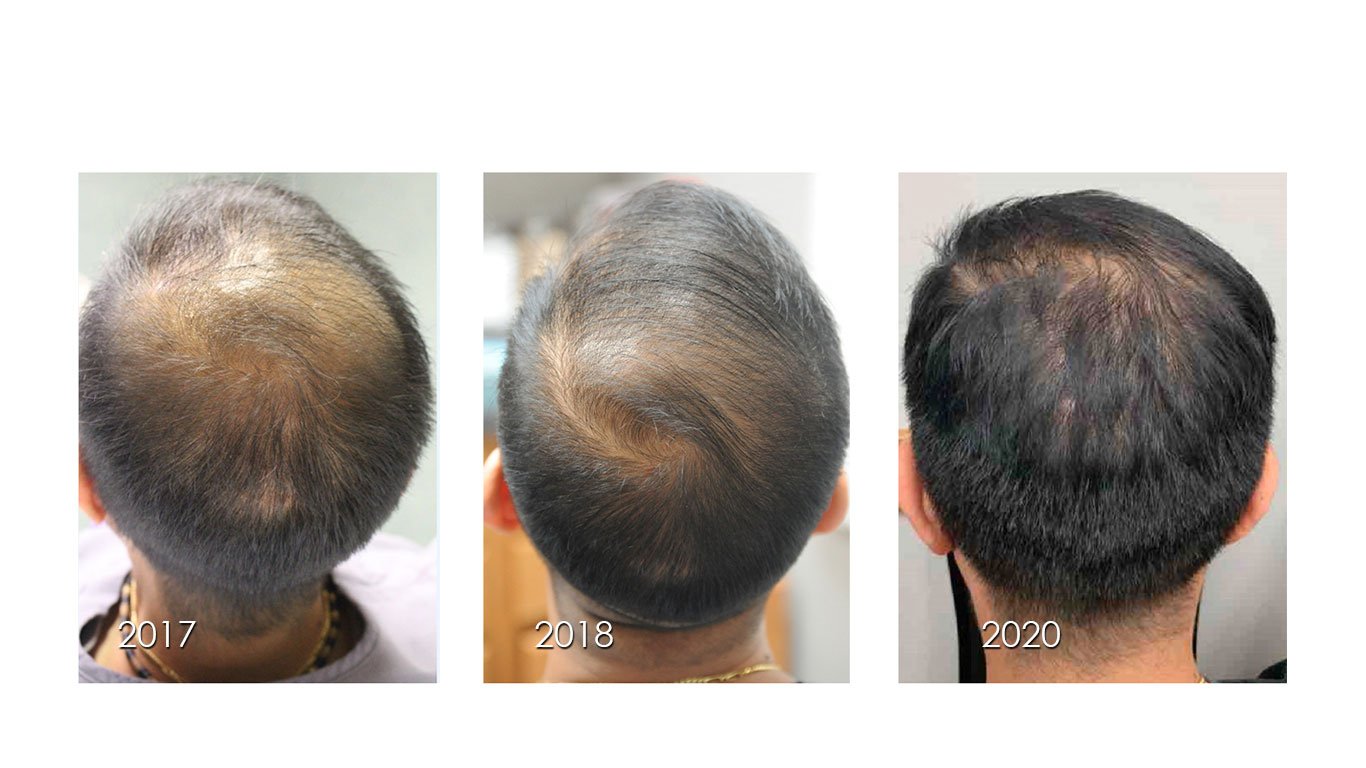 PRP terapie (Platelet Rich Plasma) in Moldova