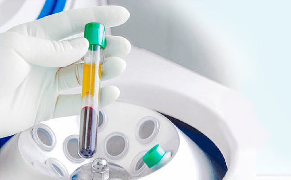 PRP terapie (Platelet Rich Plasma) in Moldova