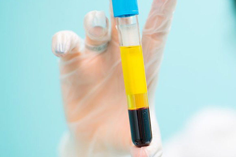 PRP terapie (Platelet Rich Plasma) in Moldova