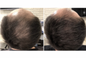 PRP terapie (Platelet Rich Plasma) in Moldova