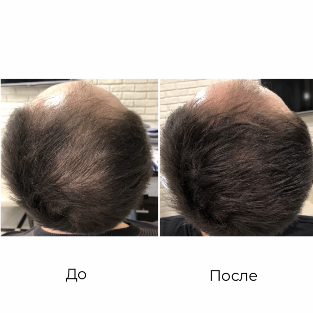 PRP terapie (Platelet Rich Plasma) in Moldova