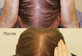 PRP terapie (Platelet Rich Plasma) in Moldova