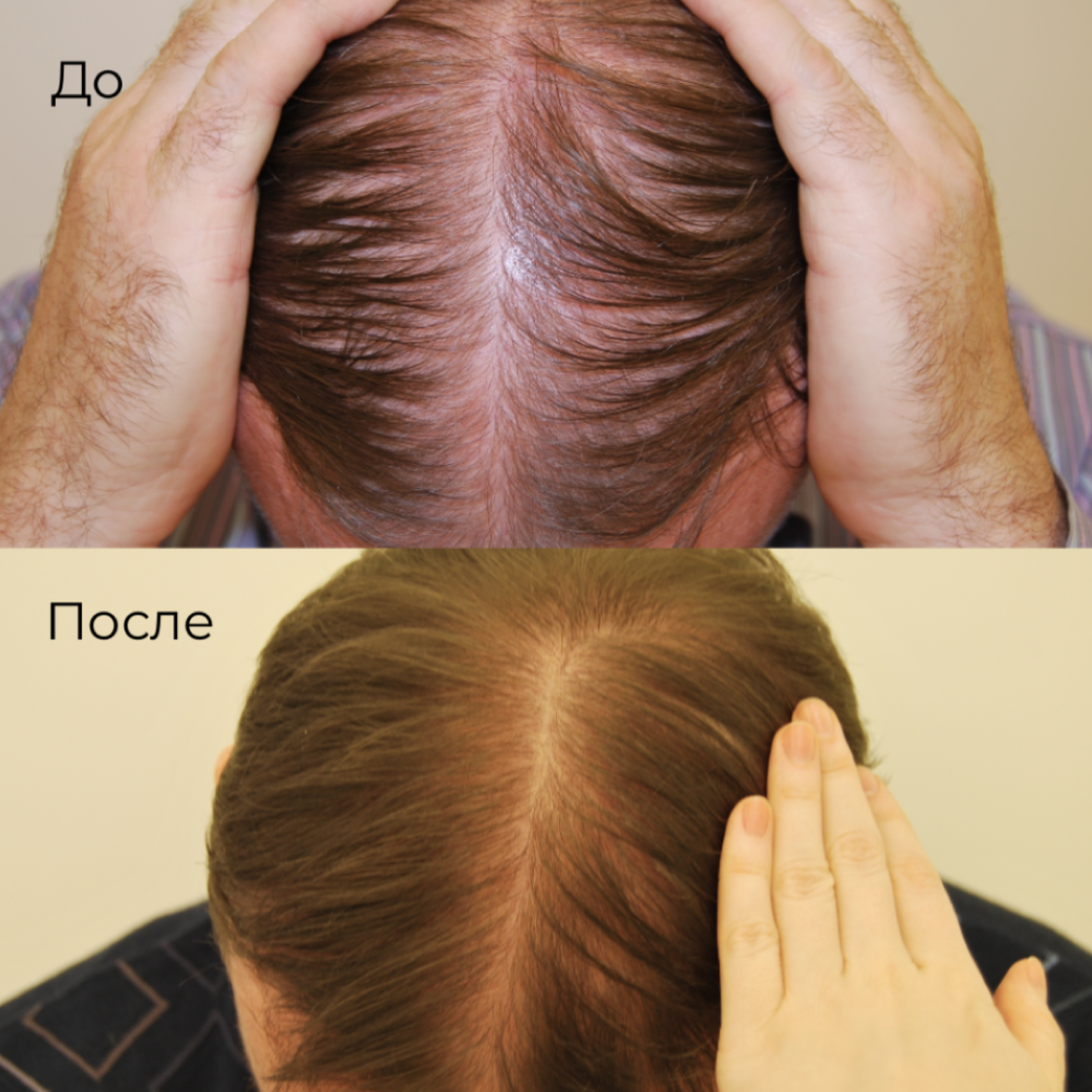PRP terapie (Platelet Rich Plasma) in Moldova