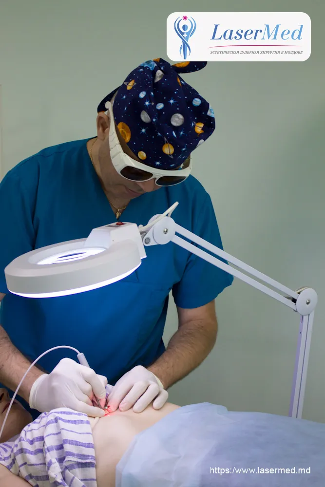 Лазерное удаление  новообразований в Молдове!