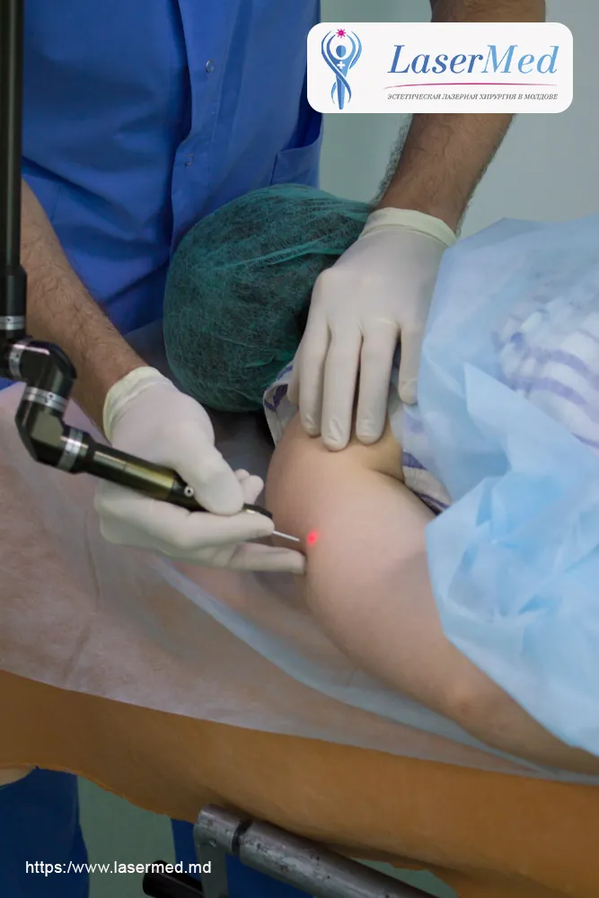 Лазерное удаление  новообразований в Молдове!