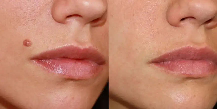 Лазерное удаление  новообразований в Молдове!