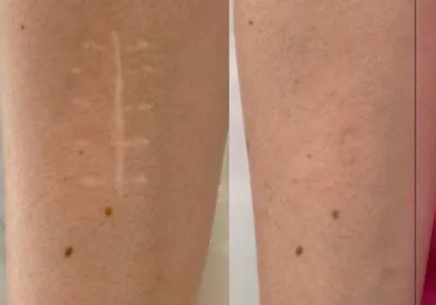 Tratament-cu-laser-pentru-indepartarea-si-eliminarea-corectia-cicatricelor-in-cabinetul-de-chirurgie-laser-LaserMedChisinau-in-Moldova