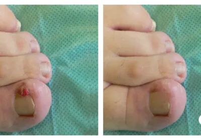 Corectie-laser-Tratament-laser-a-unghiei-incarnate-in-Chisinau-Moldova